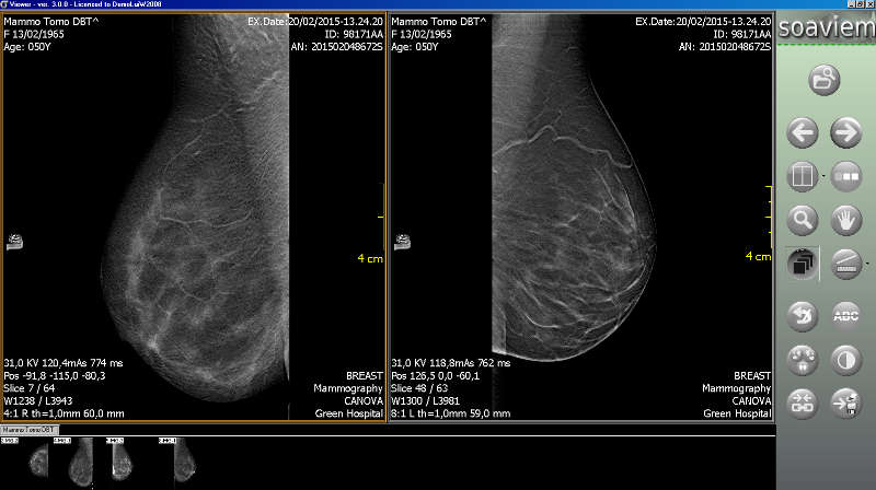 Tomosintesi mammaria dbt in sigmaviewer